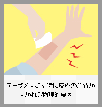 テープをはがす時に皮膚の角質がはがれる物理的要因