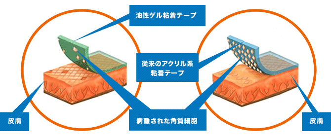 柔らかいゲル状の粘着剤なので、テープをはがすに角質をほとんどはがしません。